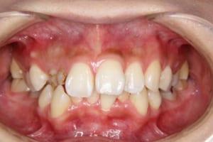 叢生、過蓋咬合、正中のずれ、乳歯の晩期残存があります